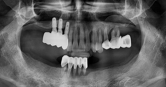 상악동거상술 증례2 Before